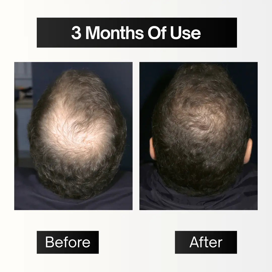 Full Pack | Hair Filler + Serum + Derma Roller